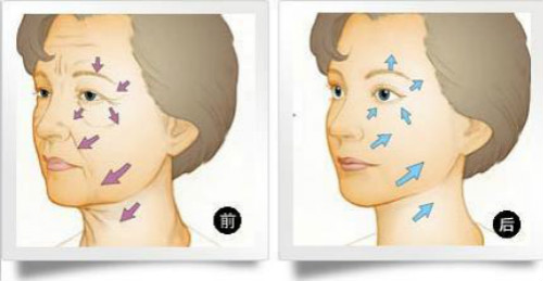 美容該儀器除皺,美容儀器安全嗎,無(wú)創(chuàng)美容儀器,無(wú)痛美容儀器